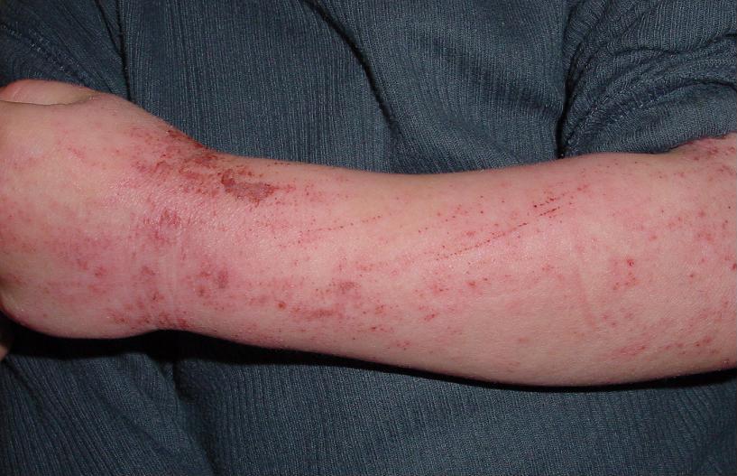 Quiet baseline eczema on arm of 5-year-old child