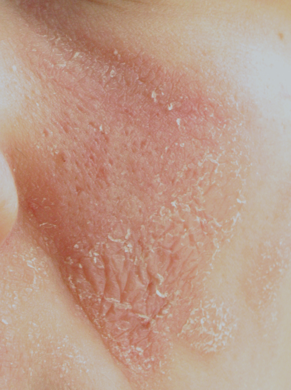 Skin flaking and desquamation during recovery